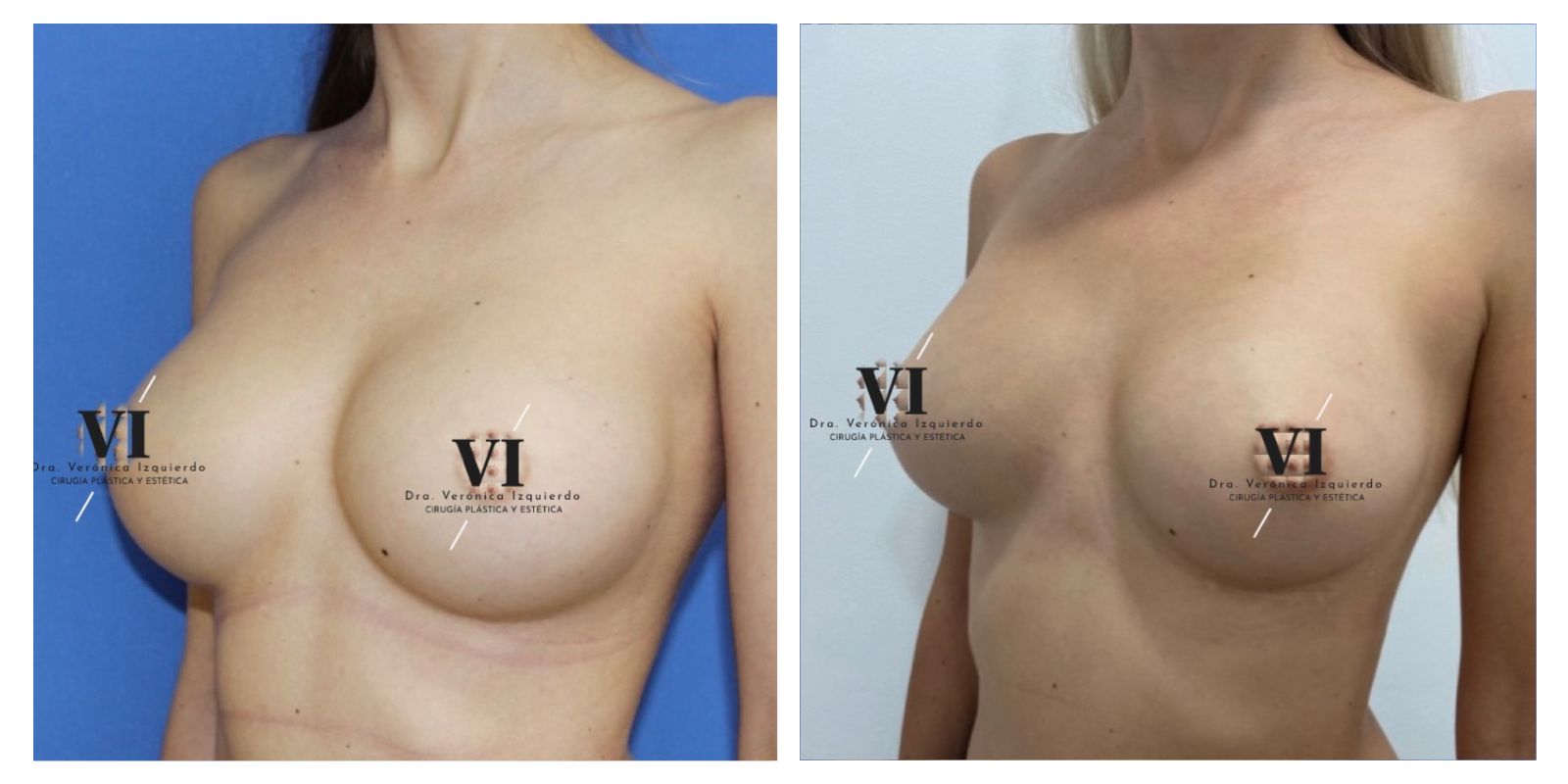 Antes y despues recambio protesis mamaria