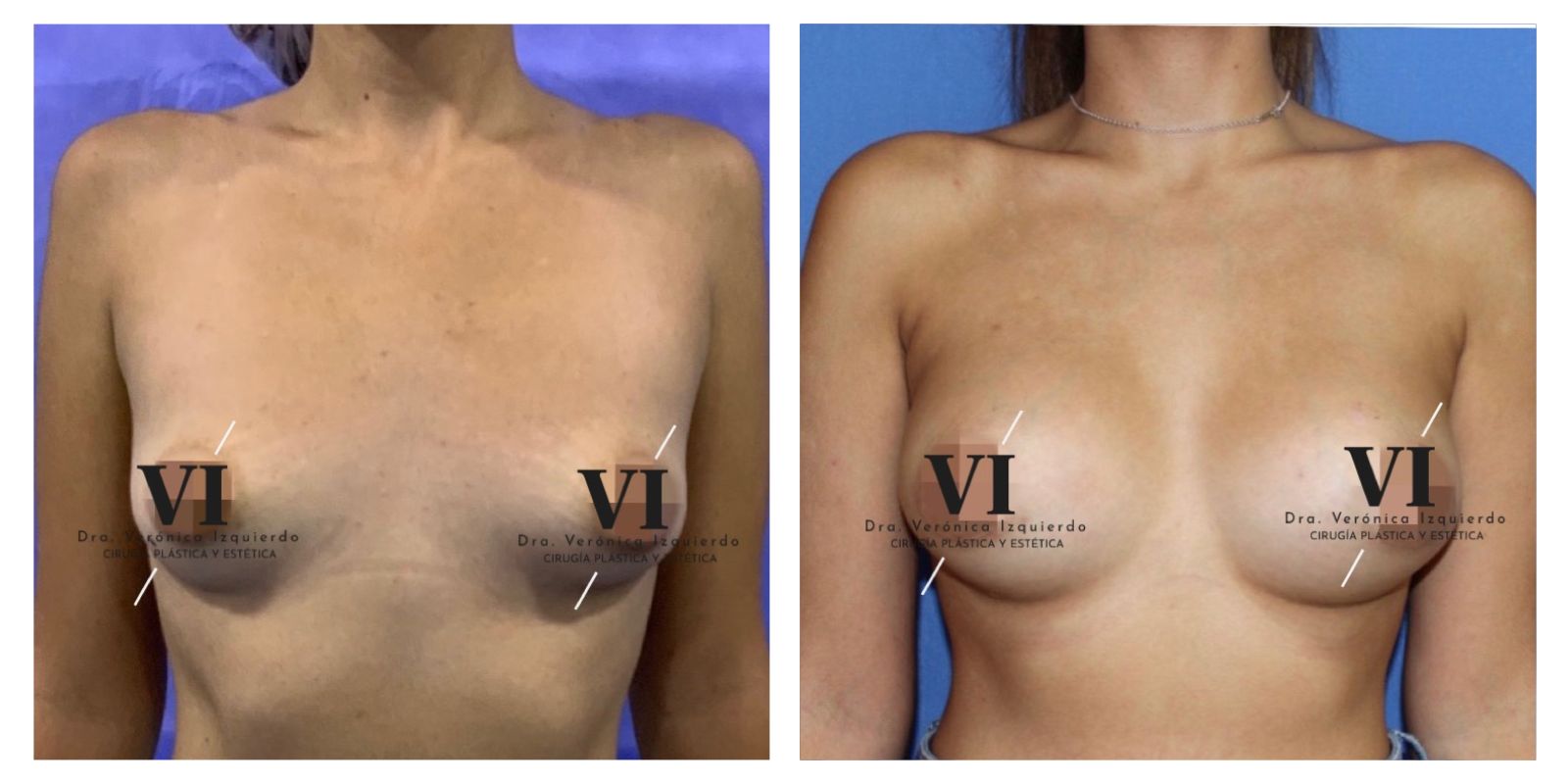 Aumento de senos con protesis antes y despues