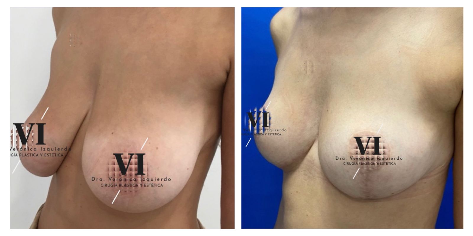 Cirugia de reduccion de senos