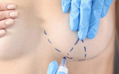 ¿Cuáles son las causas de un pecho caído? Tratamiento y cirugía