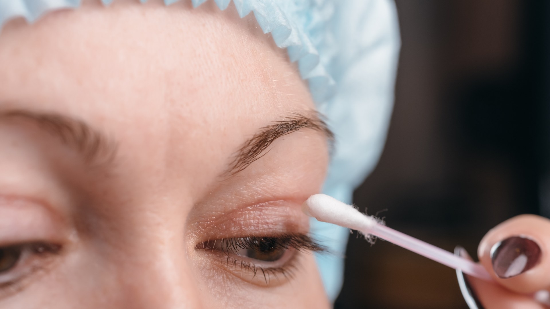 Recuperación después de la cirugía de párpados