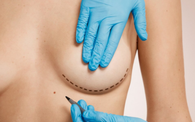 Evolución de la cicatriz tras una mastopexia: todo lo que debes saber