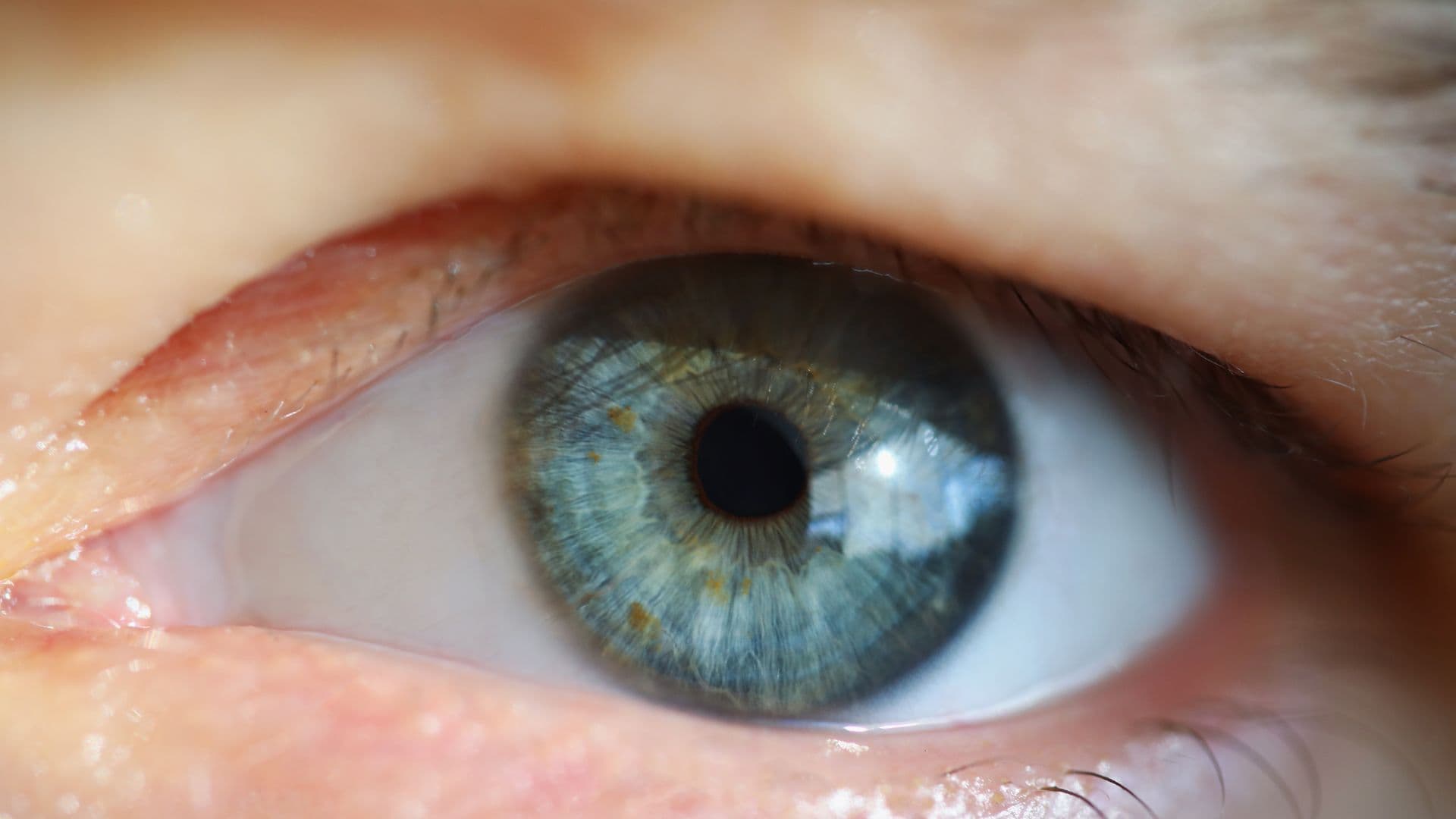 Tipos de blefaroplastia